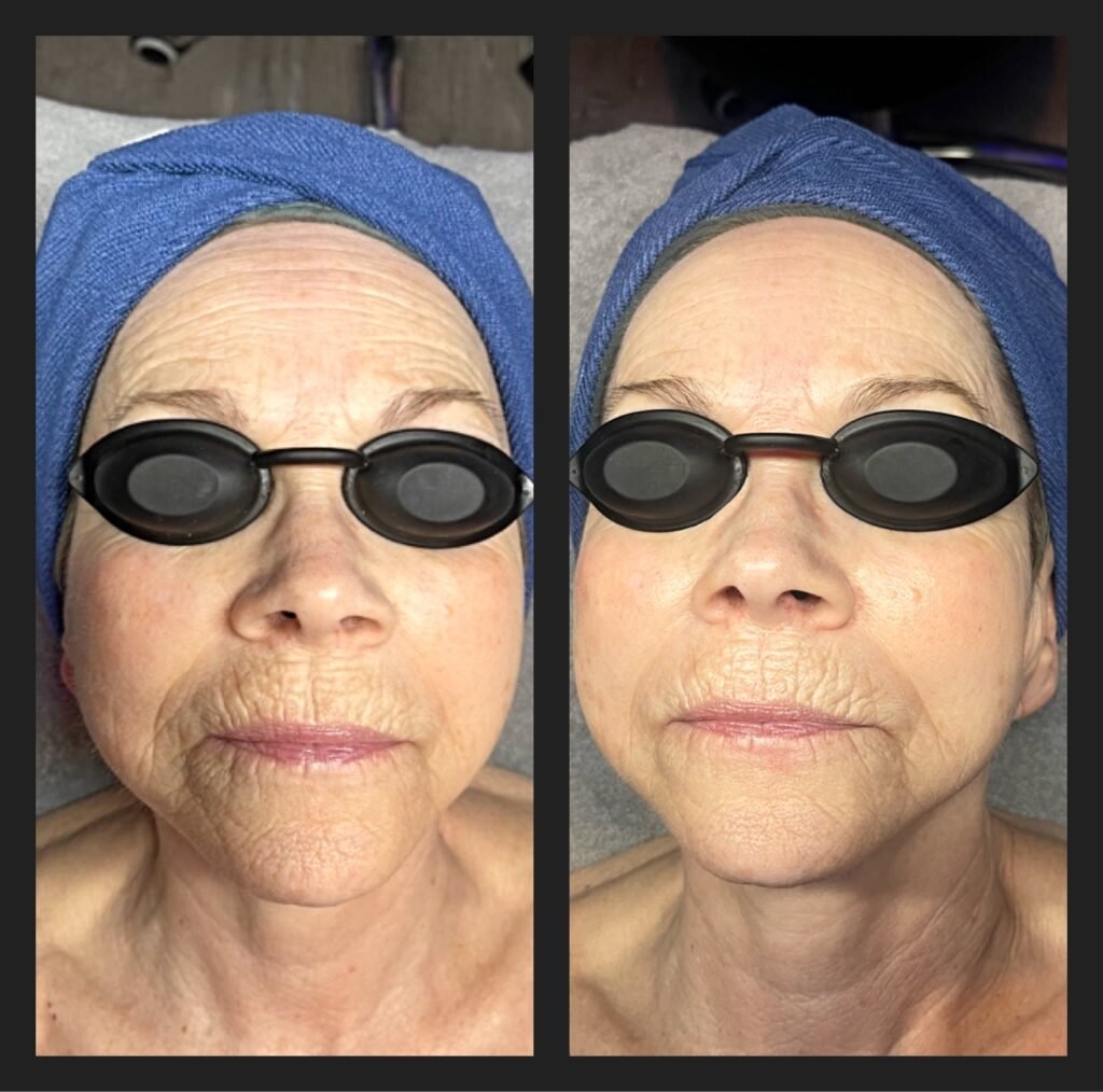 fitskin aesthetics skin treatment